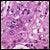 UCLA Cancer Researchers Identify Cell Origin of Squamous Cell Carcinoma