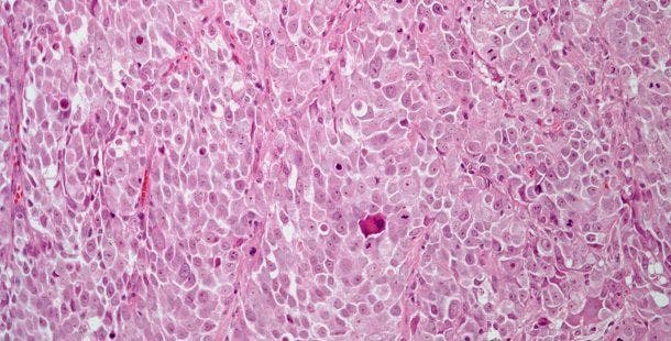 A 63-Year-Old Man Presents With Hematuria