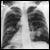Lung Cancer Deaths Not Reduced by Chest X-Ray Screening