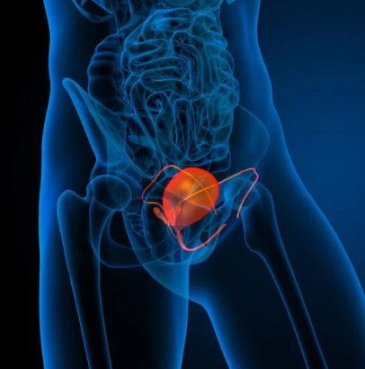Avelumab Plus Chemo Improved Survival in Muscle-Invasive Urothelial Carcinoma 