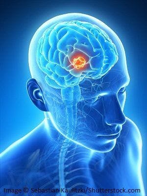 Removing Tissue Surrounding Brain Tumor May Double Survival in Patients with Glioblastoma 