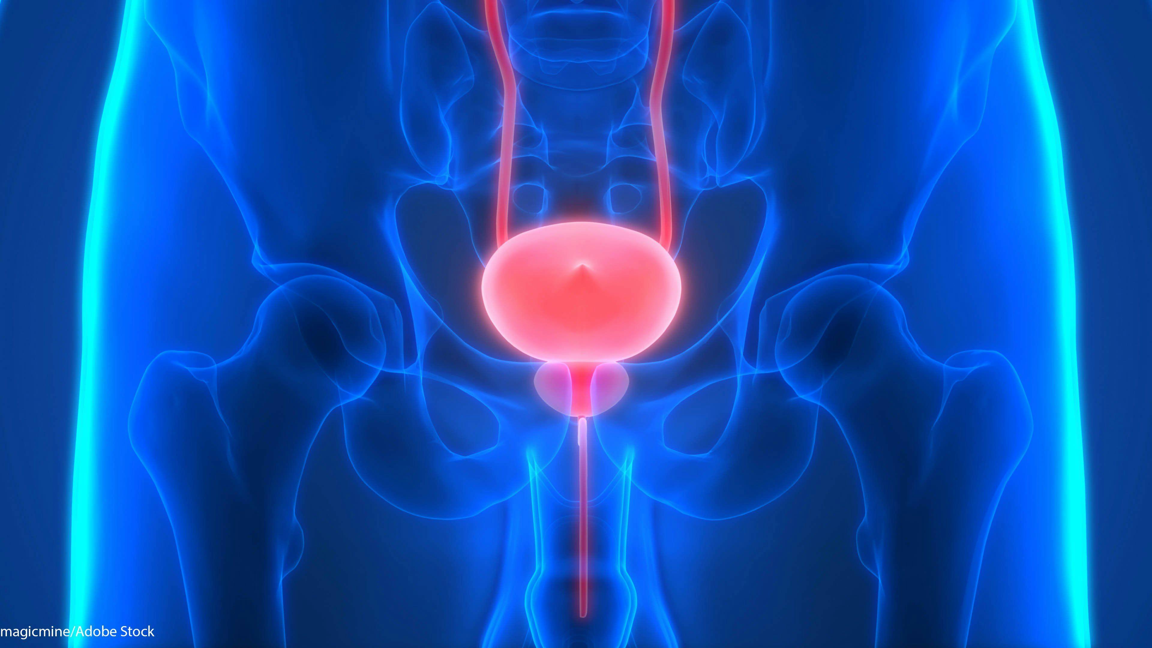 Stress Urinary Incontinence Post-Prostatectomy May Lead to Pelvic Floor Overactivity