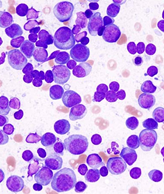 Researchers Define When Light Chain Amyloidosis is Multiple Myeloma