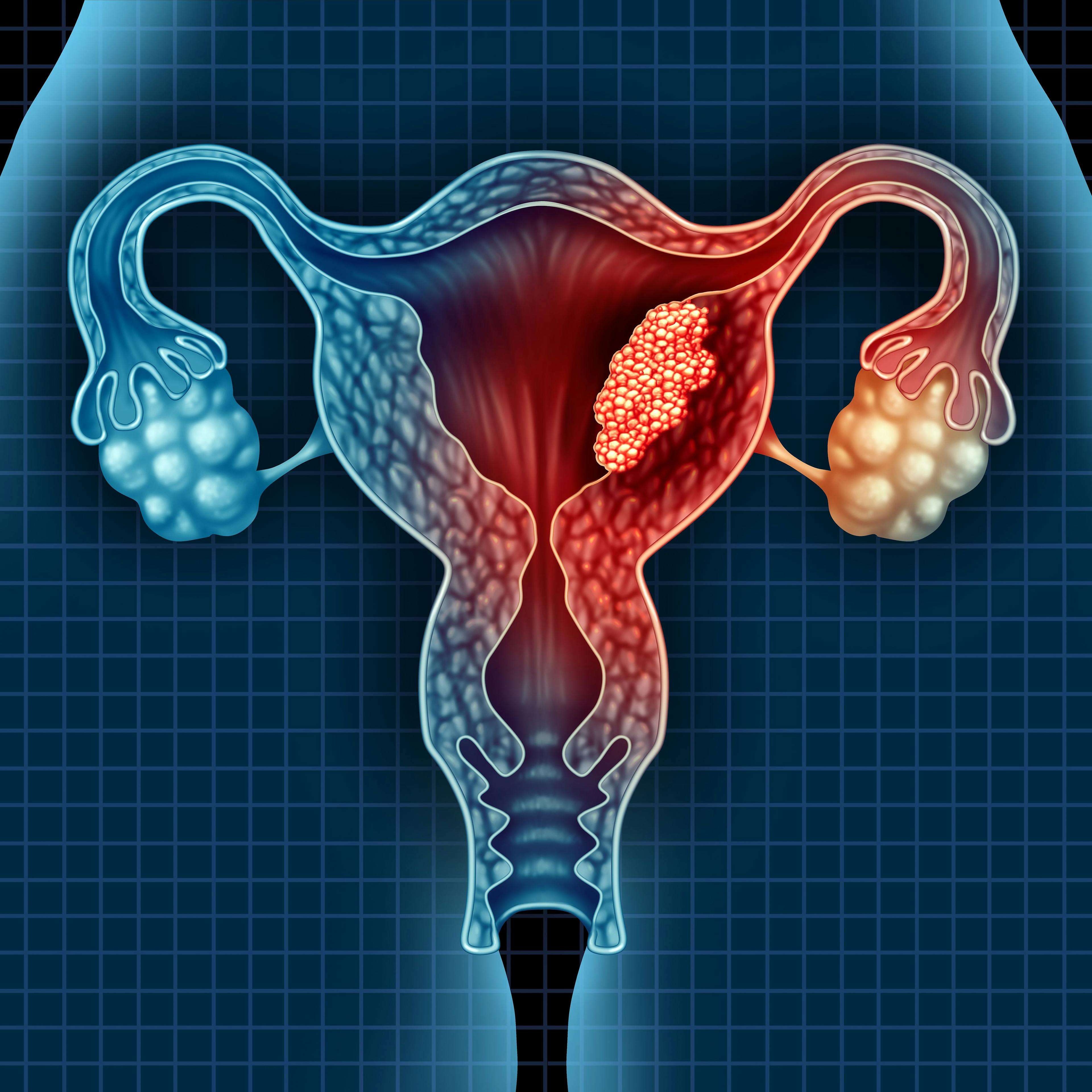 Patients with platinum-resistant ovarian cancer appear to benefit from treatment with nemvaleukin alfa and pembrolizumab, a combination which was granted a fast track designation for this indication by the FDA. 
