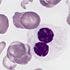 Secondary Cancer Risk Found With Multiple Myeloma Maintenance Therapies