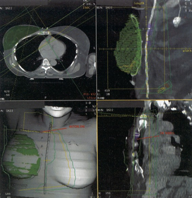 Breast Cancer Patients Prefer Radiation to Axillary Lymph Node Dissection