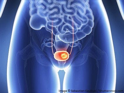 TERT Promoter Mutations Detectable 10 Years Prior to Bladder Cancer Diagnosis 