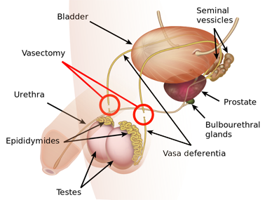 Vasectomies Linked to Higher Incidence of Prostate Cancer