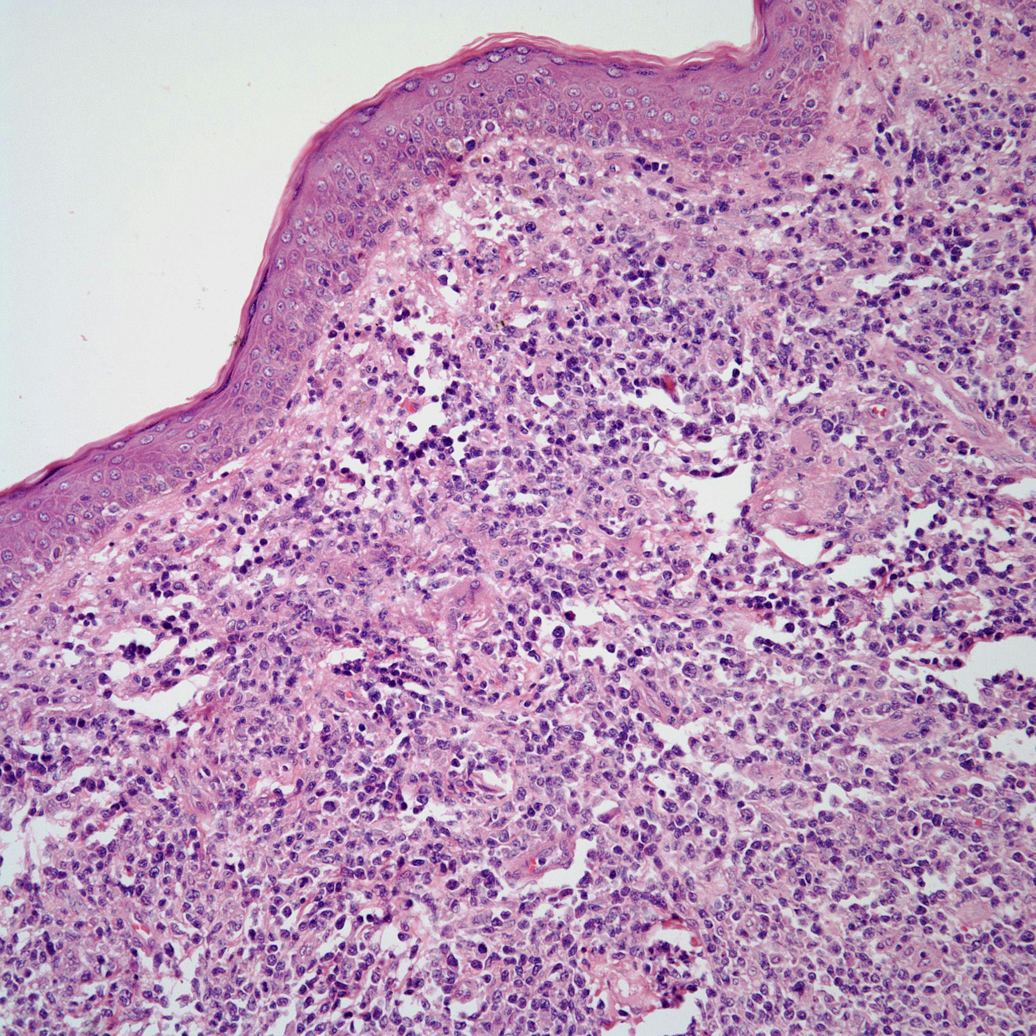 A 57-Year-Old Man With History of Pruritic Rashes
