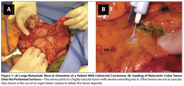 Gastrointestinal Cancers With Peritoneal Carcinomatosis: Surgery and Hyperthermic Intraperitoneal Chemotherapy