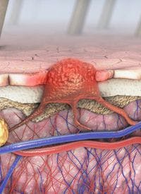 Patients with relapsed/refractory unresectable or metastatic melanoma may derive benefit from alrizomadlin, which has received a fast track designation from the FDA.