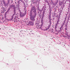 Neoplasm Lacking the Usual Genetic Markers Associated With Colorectal Neoplasms