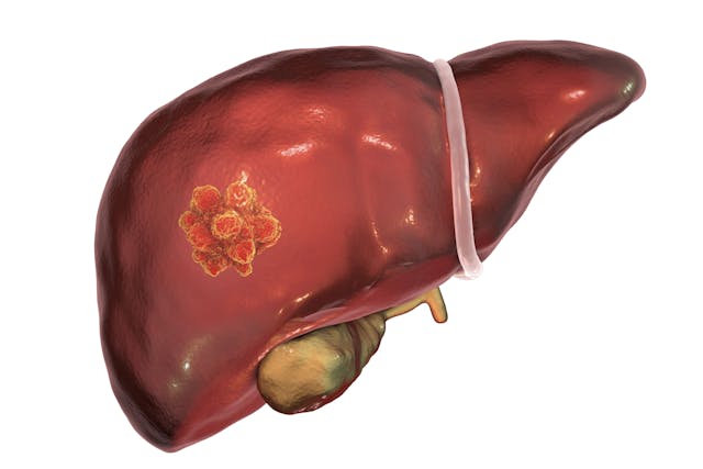The safety profile of durvalumab plus TACE and bevacizumab in patients with hepatocellular carcinoma in the phase 3 EMERALD-1 study appears to consistent with previous findings.