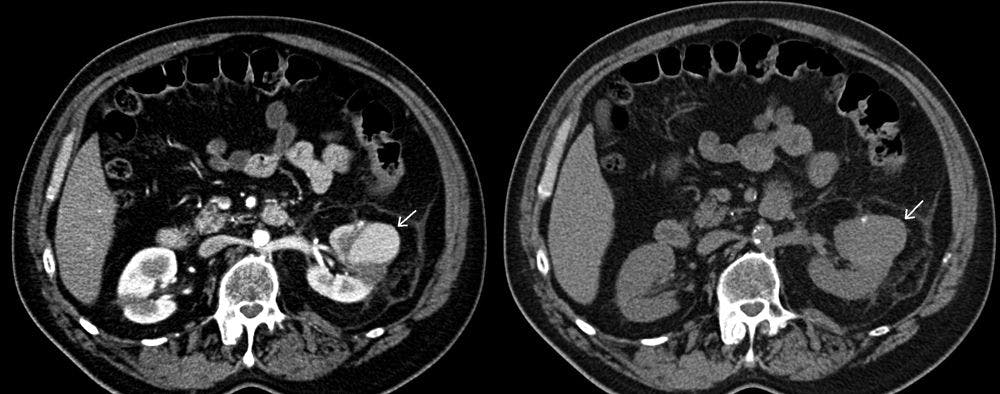 45-Year-Old Female With Gross Hematuria Post Partial Nephrectomy