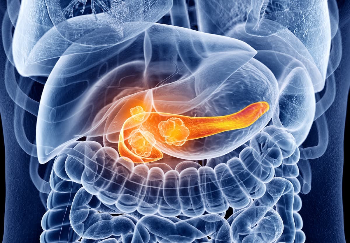 Developers plan to initiate clinical trials evaluating the efficacy and safety of MAb-AR20.5 in those with pancreatic cancer in the future.