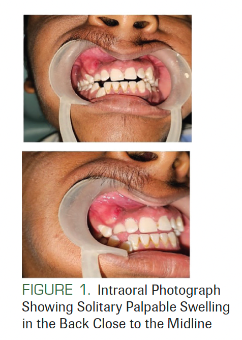FIGURE 1. Intraoral Photograph Showing Solitary Palpable Swelling in the Back Close to the Midline