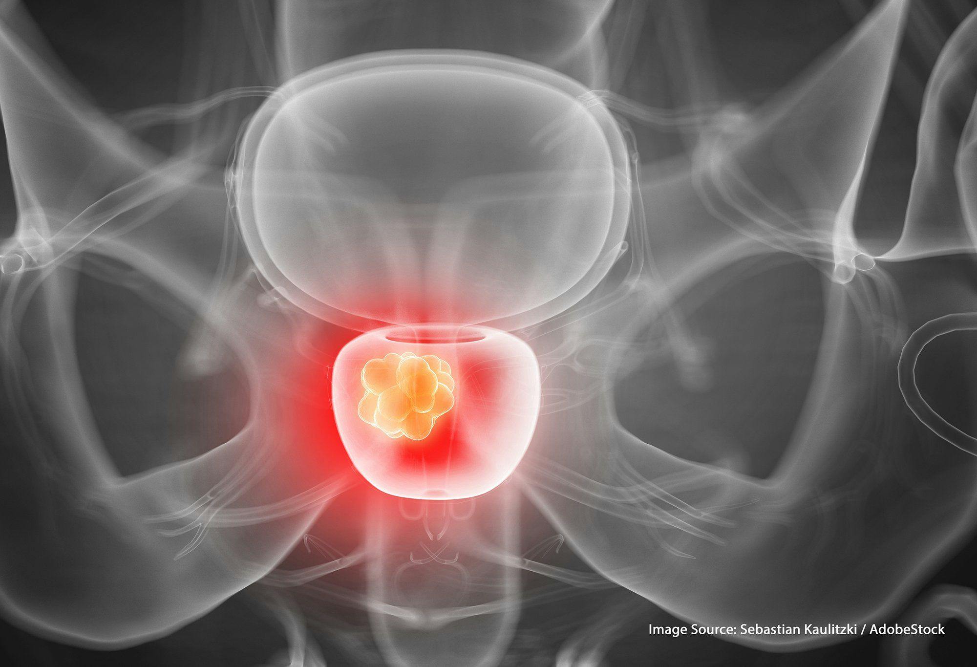 Apalutamide Plus ADT Shows Benefit in Castration-Sensitive Prostate Cancer