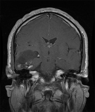 Oligodendroglioma: MRI T1 with gadolinium contrast