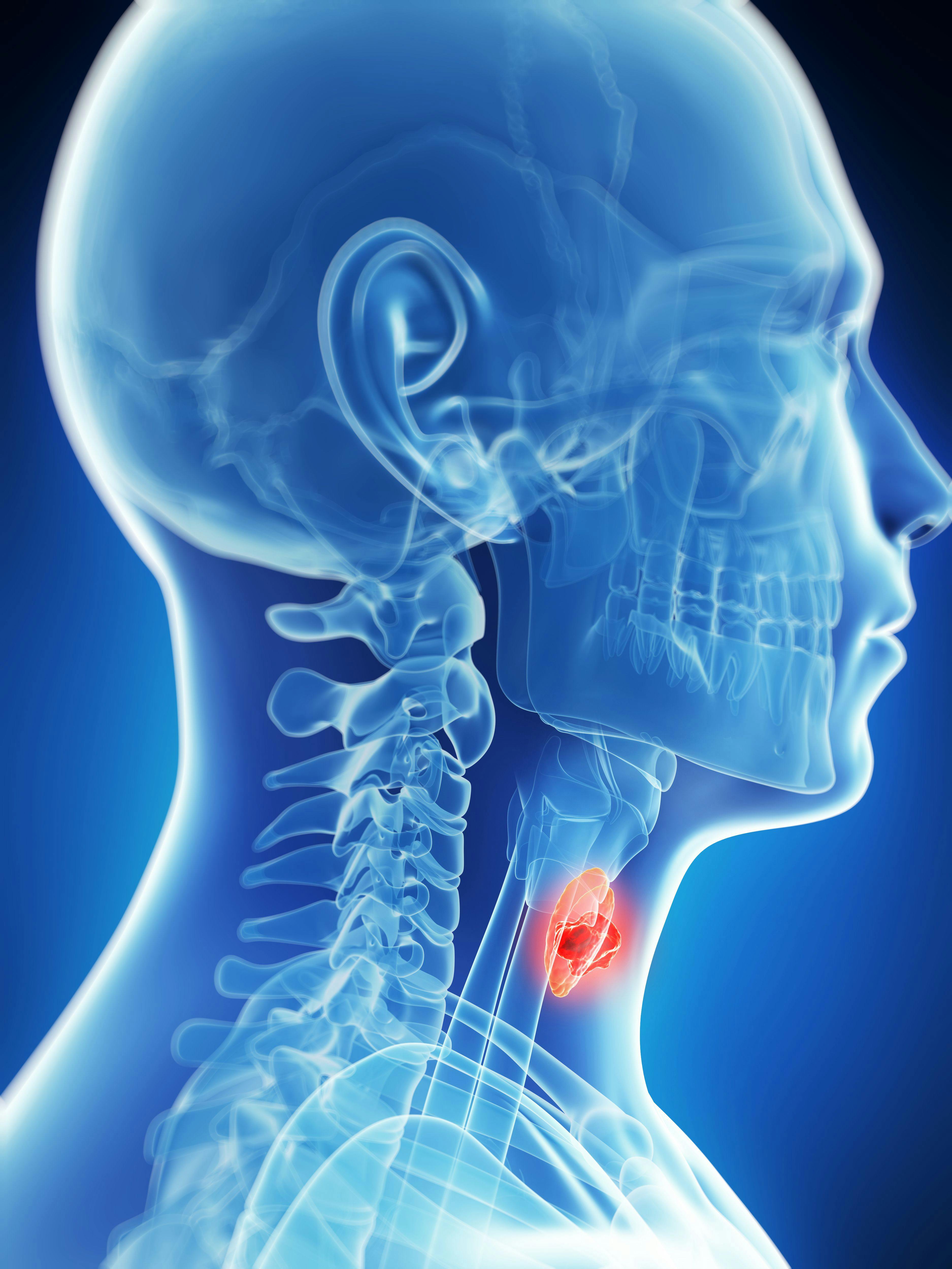 Sintilimab plus chemoradiotherapy produces a higher 3-year distant metastasis-free survival rate vs chemoradiotherapy alone among patients with advanced nasopharyngeal carcinoma in the phase 3 CONTINUUM trial.