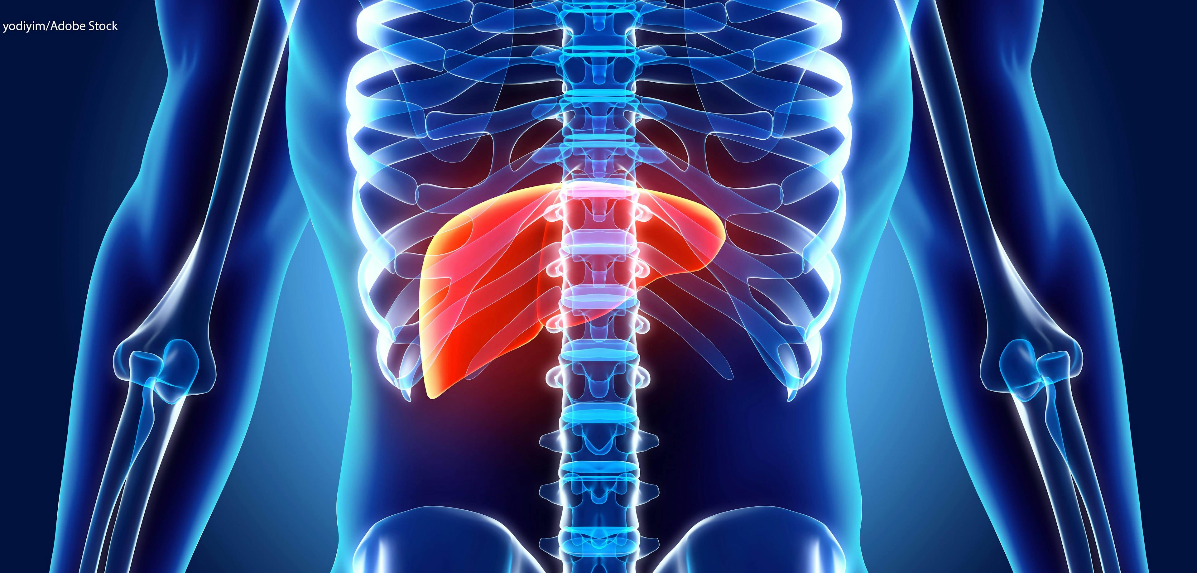 Research Suggests Liver Cancer Prevention Strategy Should Include NASH, Elderly Patients