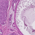 Mammary Gland Biopsy of 38-Year-Old Patient
