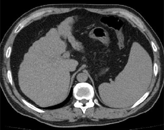 Abdominal CT showing liver cirrhosis