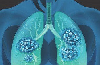 Experts Address Difficulties in Lung Cancer Management During COVID-19 Pandemic