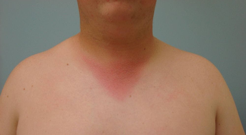 A 67-Year-Old Male Cancer Patient Presents With a Painful Erythema Involving the Face, Arms, and Chest