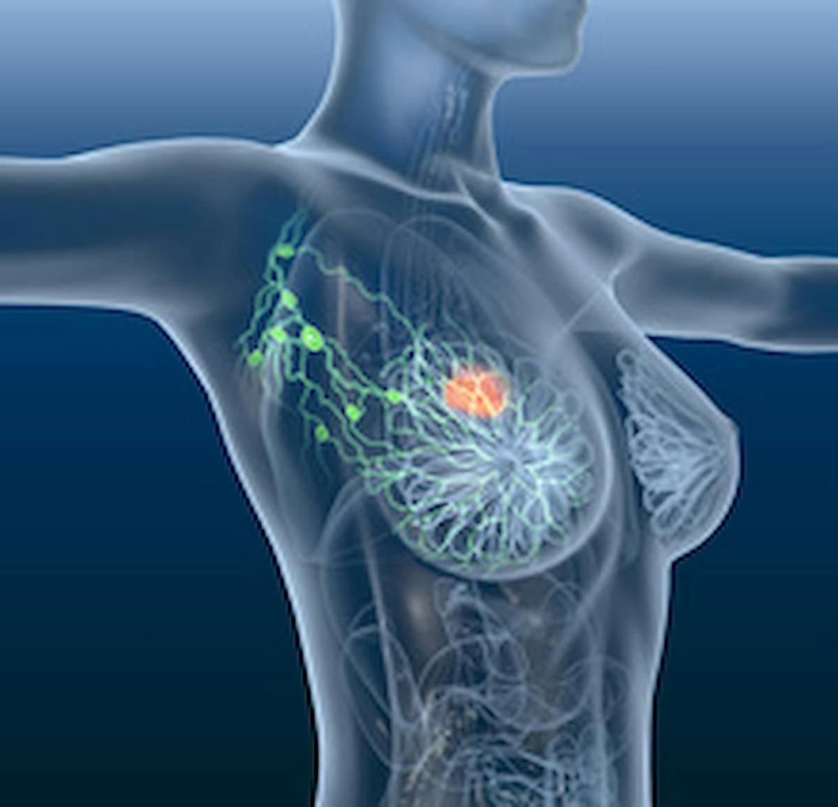 Among patients with advanced and/or metastatic hormone receptor–positive HER-2 negative breast cancer, complete estrogen receptor antagonist OP-1250 continued to yield clinical benefits such as reductions in target tumor lesions.