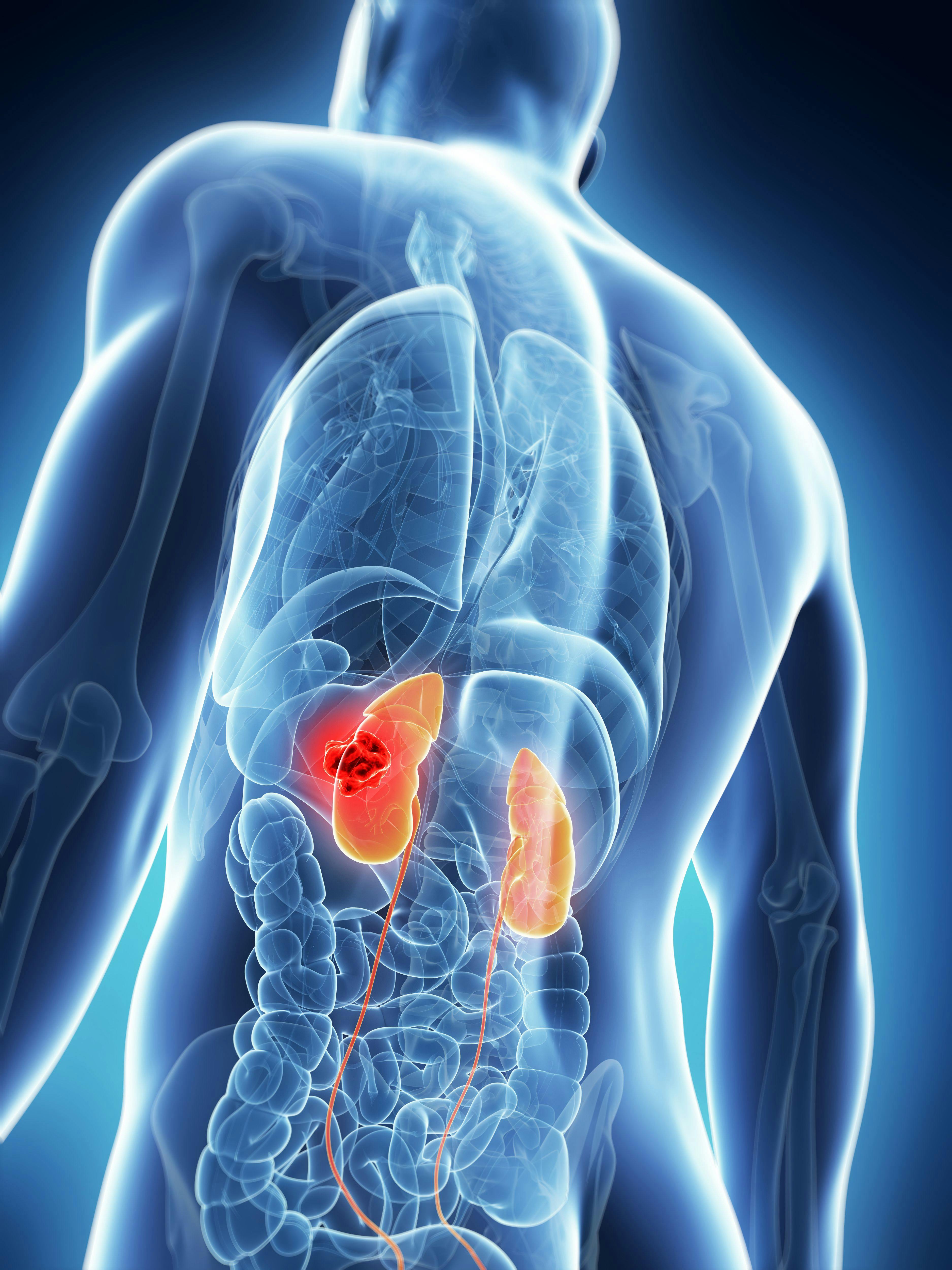 Cabozantinib Combo Shows Boost in Efficacy in Advanced Kidney Cancer Subgroups