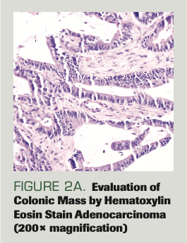 FIGURE 2A. Evaluation of Colonic Mass by Hematoxylin Eosin Stain Adenocarcinoma (200× magnification)