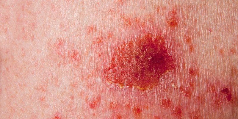Novel, Immune Therapies Promising in Nonmelanoma Skin Cancers