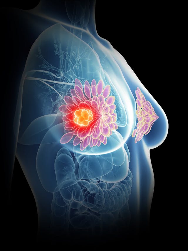Bria-IMT plus retifanlimab continues to show positive clinical outcomes in a small cohort of patients with advanced, metastatic breast cancer, according to new data from a phase 1/2 trial.