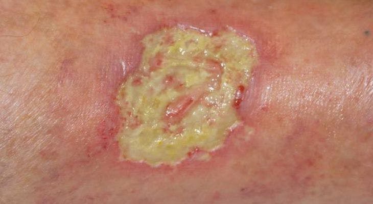 A 46-Year-Old CML Patient Develops Painful Ulceration