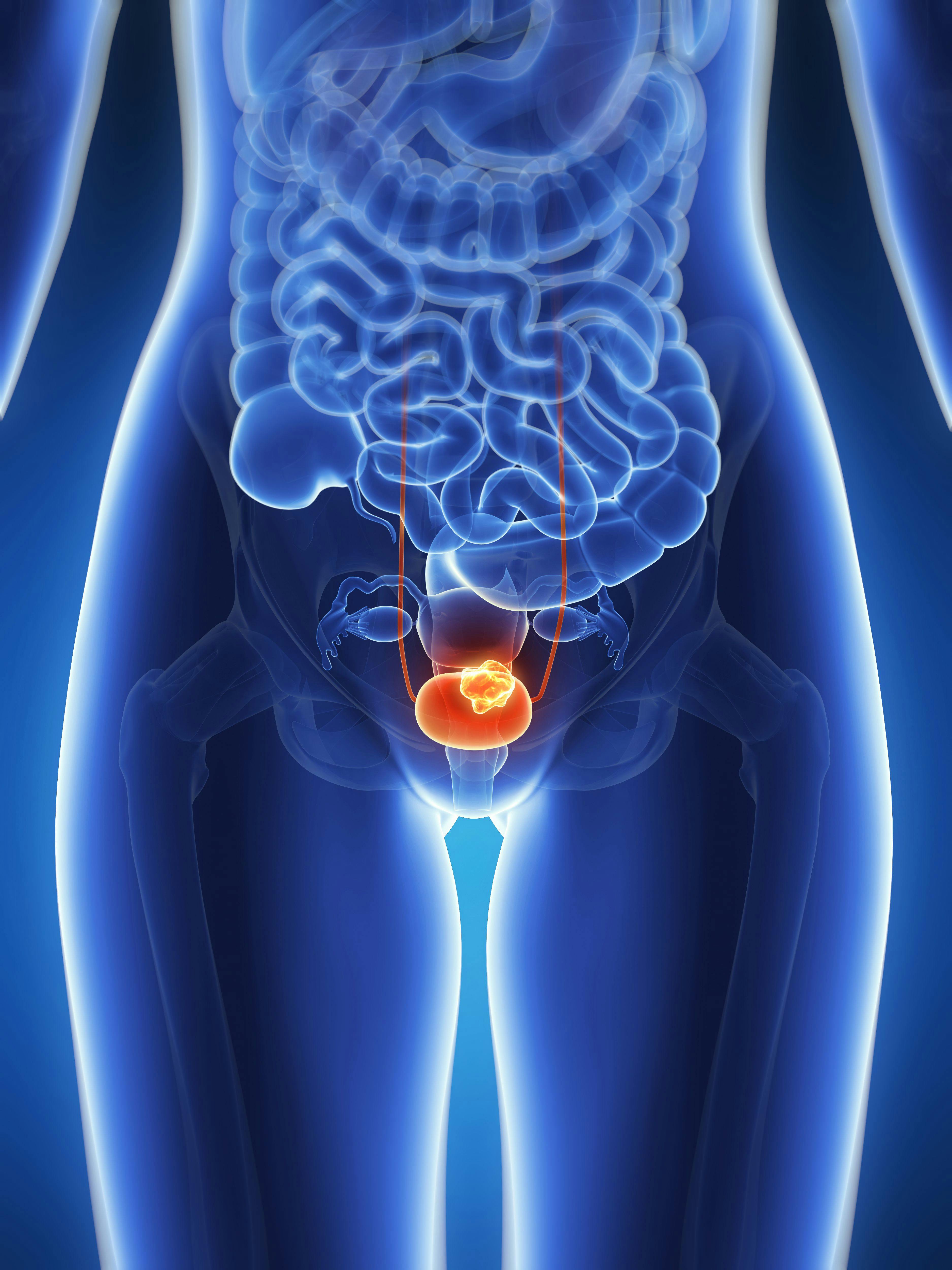 Patients with metastatic urothelial carcinoma did not derive further benefit from the addition of berzosertib to cisplatin and gemcitabine.