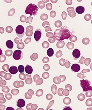 B-cell chronic lymphocytic leukemia