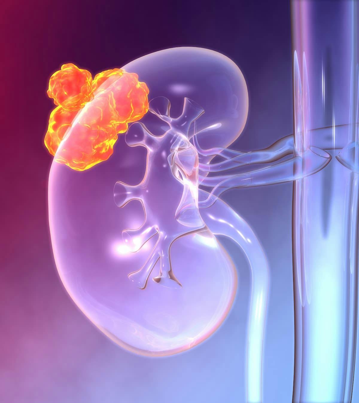 Integrative Modalities Are ‘Extremely Safe’ in Kidney Cancer Care | Image Credit: © Axel Kock - stock.adobe.com.