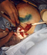 Blue stained lymph nodes removed through small incision