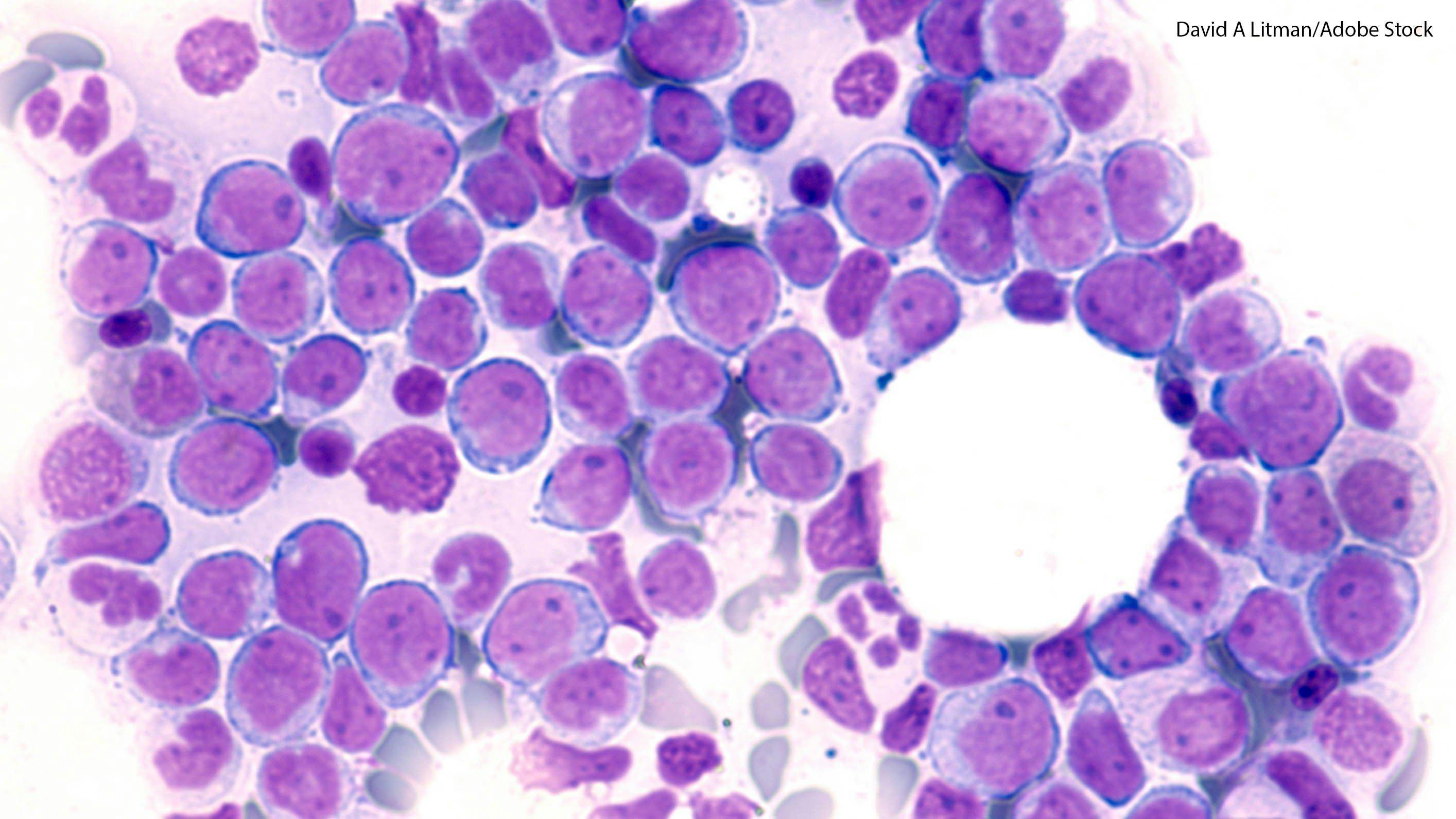 Gal9/TIM-3 Expression Levels Affects Chemotherapy in Leukemia Patients 