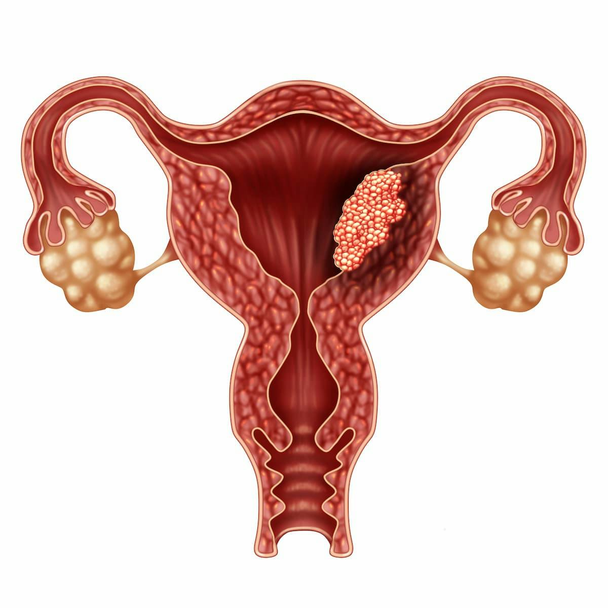 DUO-E Trial Meets PFS End Point in Advanced/Recurrent Endometrial Cancer | Image Credit: © freshidea - stock.adobe.com.