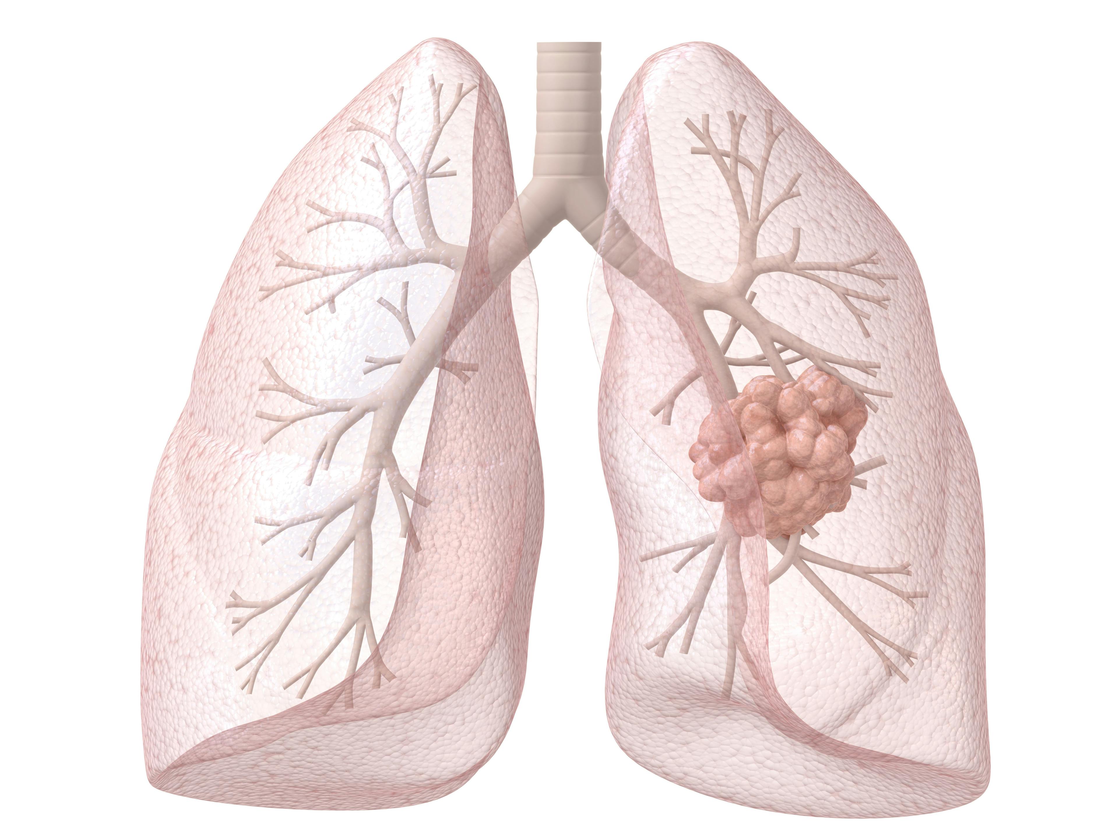 The New Era In Lung Cancer Care