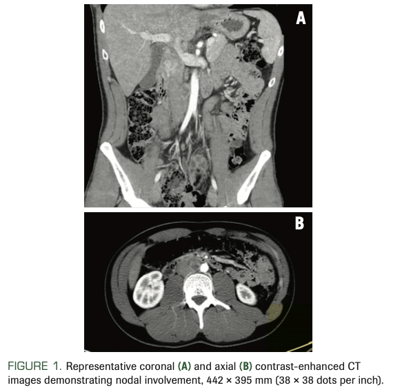 FIGURE 1. Representative coronal (A) and axial (B) contrast-enhanced CT images demonstrating nodal involvement, 442 × 395 mm (38 × 38 dots per inch).