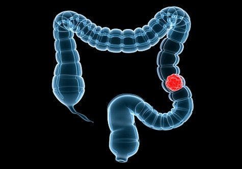 New Targeted Treatment IMMU-130 for Patients With Metastatic Colon Cancer