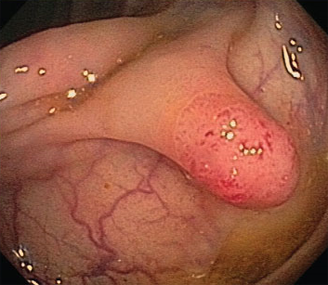The head of this pedunculated polyp is erythematous and consists of adenomatous