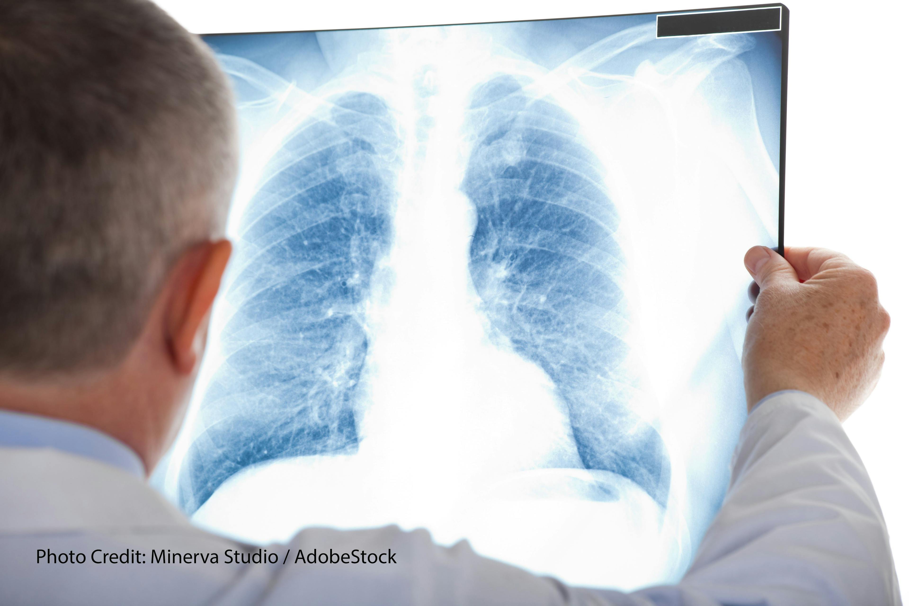 NCCN: Updated NSCLC Guidelines Hone in on PD-L1 Testing