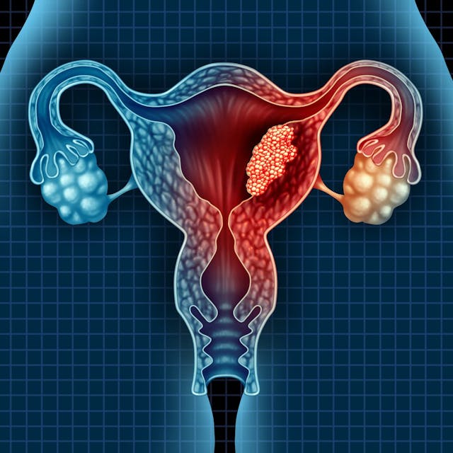 The European approval for dostarlimab and chemotherapy for dMMR/MSI-H, primary advanced or recurrent endometrial cancer is based on data from part 1 of the phase 3 RUBY/ENGOT-EN6/GOG3031/NSGO trial.