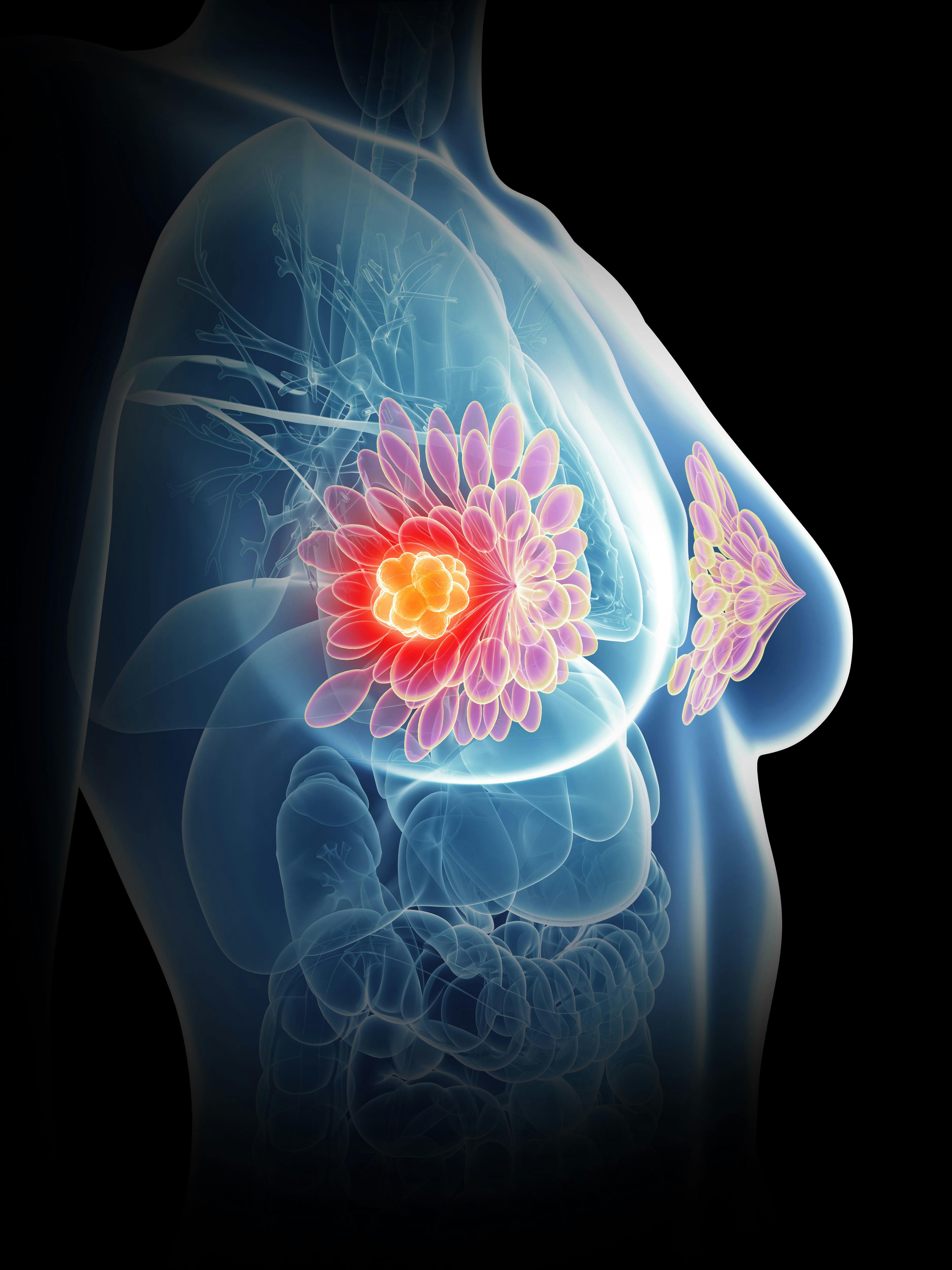 Fulvestrant Plus Capivasertib Improved Survival Vs Fulvestrant/Placebo in ER+, HER2– Advanced Breast Cancer 