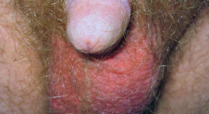 RCC Patient Develops Erythema and Scaling on Scrotum