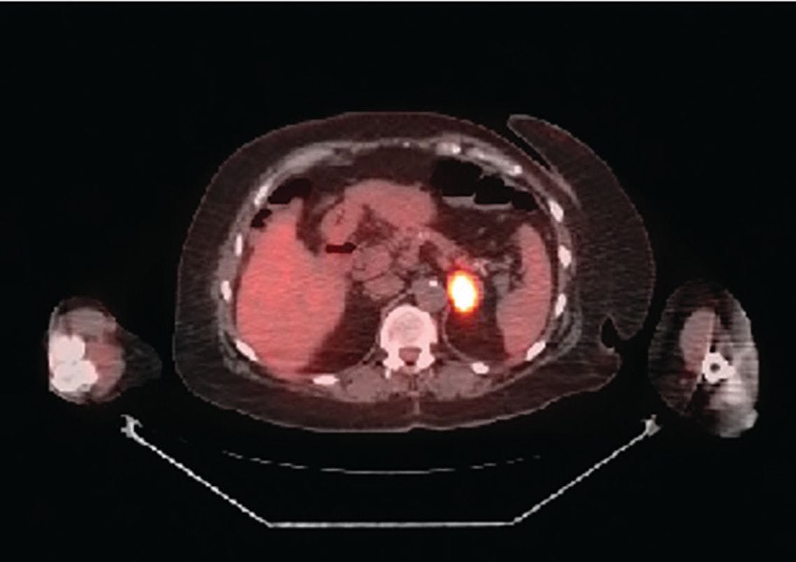 Recurrent EGFR-Mutated Non–Small Cell Lung Cancer Discovered by Abnormal Mammogram: Adjuvant/Frontline Metastatic Management Options 