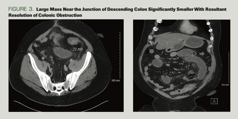 FIGURE 3. Large Mass Near the Junction of Descending Colon Significantly Smaller With Resultant Resolution of Colonic Obstruction